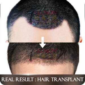 HAIR TRANSPLANT