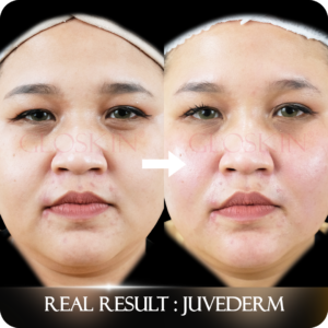 JUVEDERM